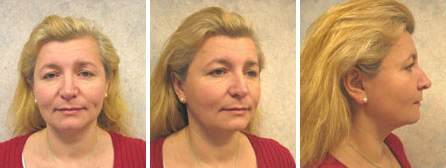 Facelift Before Image